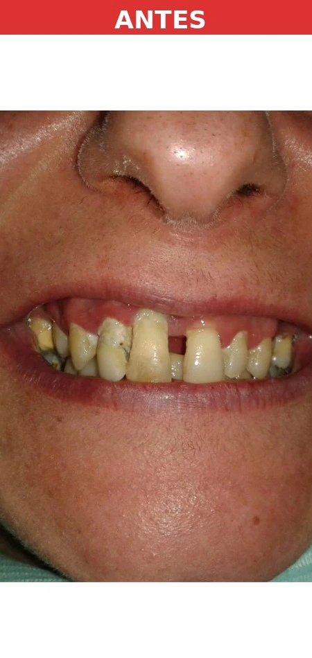 Paciente antes del implante dental Hortaleza