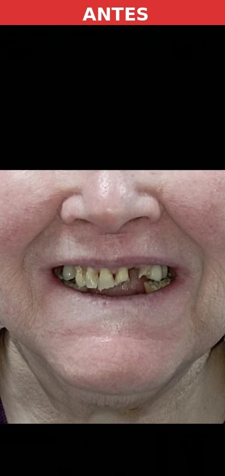 Paciente antes del implante dental Sanchinarro