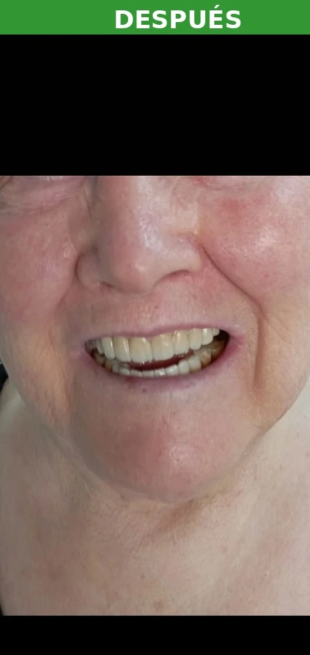 Resultado implante dental Sanchinarro — después