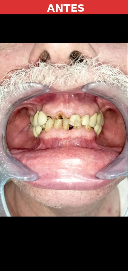 Paciente antes del implante dental Las Tablas