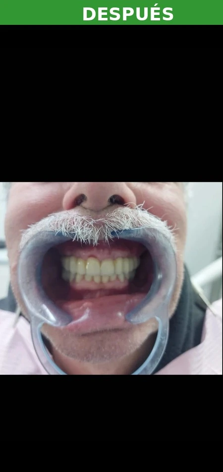 Resultado implante dental Las Tablas — después